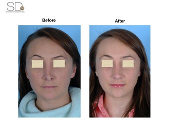 Revision Rhinoplasty before 100949