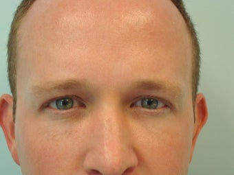 Undereye Filler after 583371
