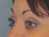 Brow Lift 541478