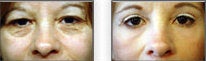 Upper and Lower Blepharoplasty before 88834