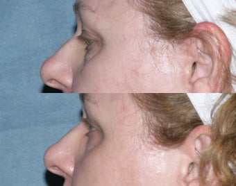 Laser resurfacing under the eyes before 130363