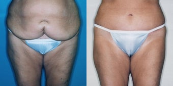 Tummy Tuck + Lipo after Hysterectomy before 350958