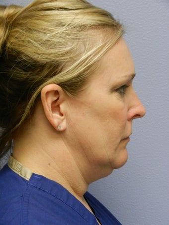 Laser Liposuction 555894