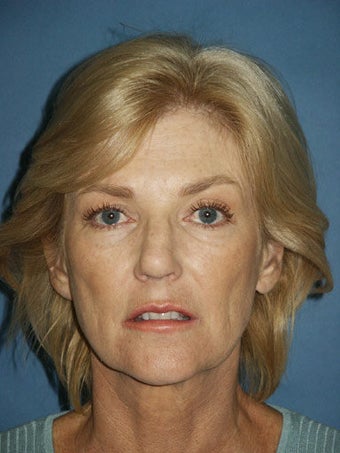 Facelift, Endoscopic Browlift, Upper and Lower Blepharoplasty, Lip Augmentation with Fat injections before 248853