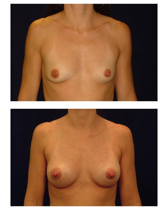 Breast Augmentation before 149515