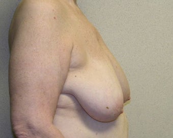 Breast Lift 411125