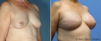 Breast reconstruction before 270821