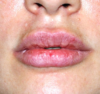 Lip Augmentation after 536185