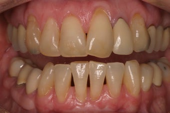 alloderm tissue graft before 330727