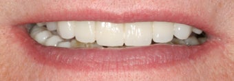 Full mouth reconstruction after 486454