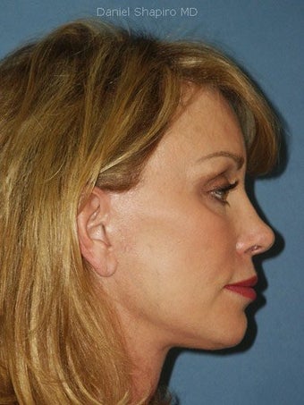 Facelift, Endoscopic Browlift, Chemical Peel to the Lower Eyelids after 248886