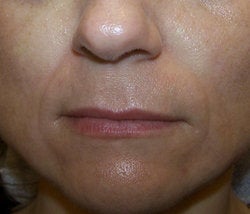 Juvederm before 87081
