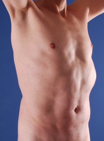 Tummy Liposuction after 229669