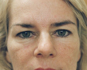 Eyelid rejuvenation before 378932