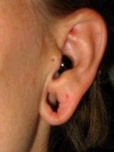 Earlobe Repair before 146612