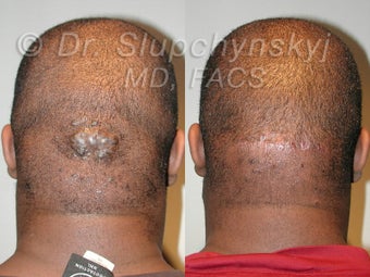 Keloid Removal before 548934