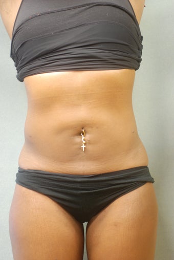 SmartLipo Abs & Love Handles 356690