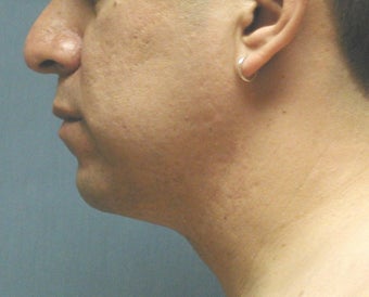 chin liposuction after 409998