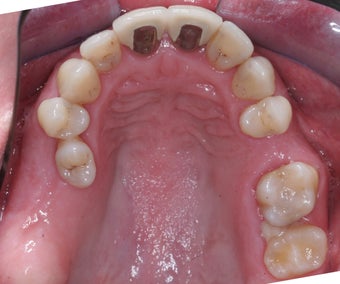 Invisalign, implants, whiteing and veneers 372730
