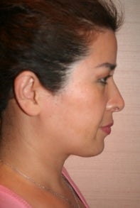 Asian Rhinoplasty after 448671