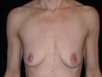 Breast augmentation before 381904