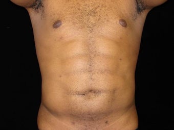 Liposuction of Abdomen, Waist, Flanks, Pecs with 6 Pack Abdominal Etching after 203529