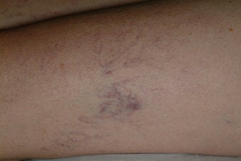 Sclerotherapy before 95916
