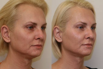 Ultherapy before 532607