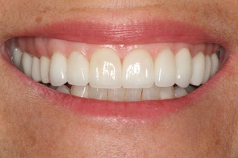 Full upper arch of veneers after 244071