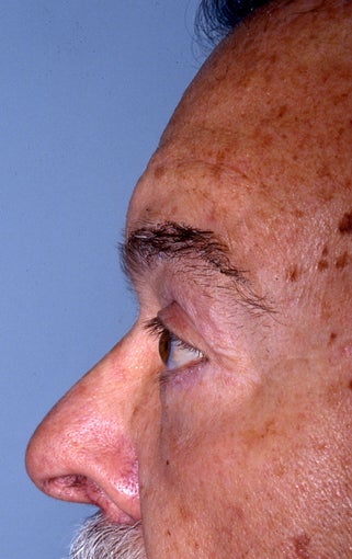 Blepharoplasty 322229