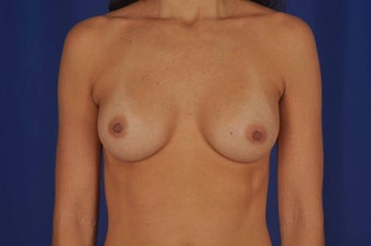 39 year-old woman desired breast implants after 634063