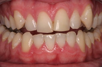 porcelain crowns before 330389