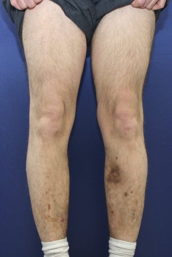 vnus ablation after 297051