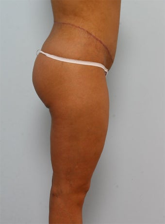 Body Lift after 260116