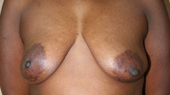 Breast Reconstruction before 517492