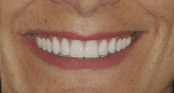 Smile makeover after 478964
