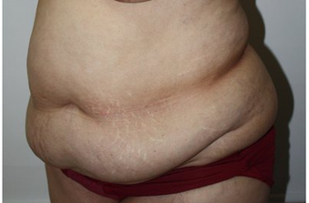 abdominoplasty before 211422