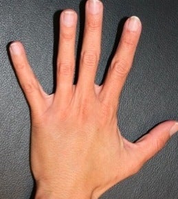 Hand rejuvenation after 374249