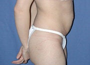 Abdominoplasty before 151311