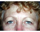 Eye Lid Lift Surgery (Blepharoplasty) before 155478
