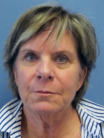 Neck Lift, Platysmaplasty before 634723