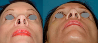 Revision Rhinoplasty (open) 306788