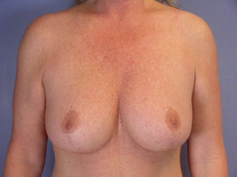 Breast Lift after 321468