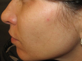Isolaz treatment after 272102