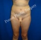 Liposuction before 632169