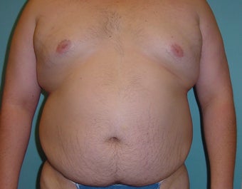 Male liposuction/liposculpture before 314976