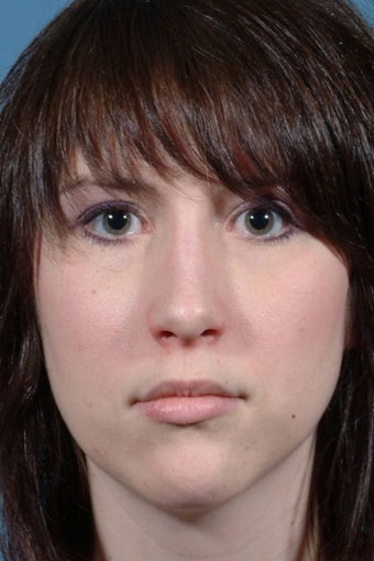 Revision Rhinoplasty after 81097