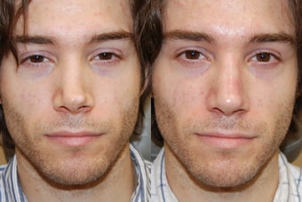 Non-Surgical Rhinoplasty with Silikon-1000 for permanent results. before 216825