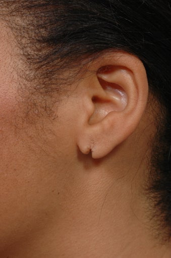 Earlobe Repair before 352442