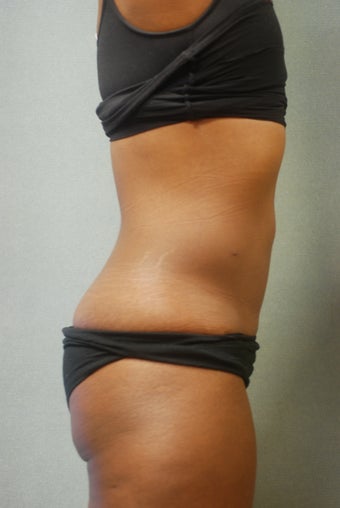 SmartLipo Abs & Love Handles after 356690